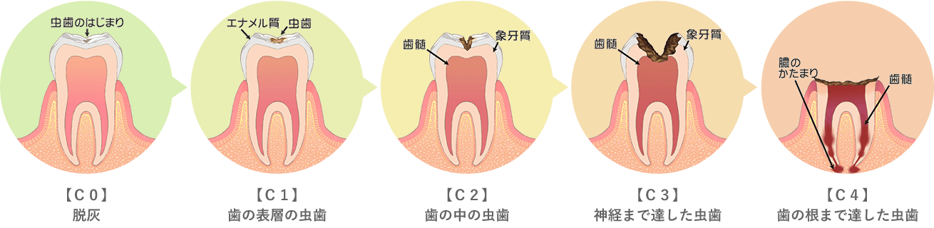 虫歯の進行