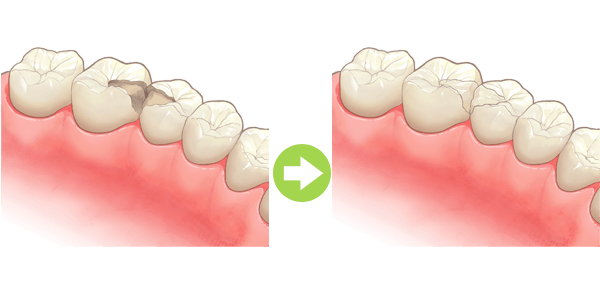 歯の中（象牙質）の虫歯