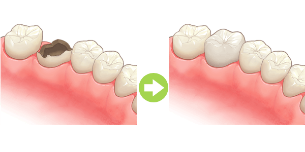 神経まで達した虫歯