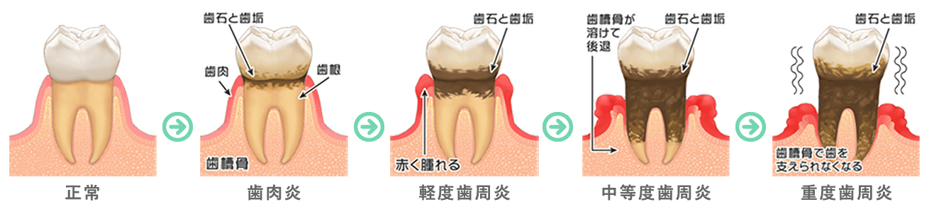 歯周病の進行