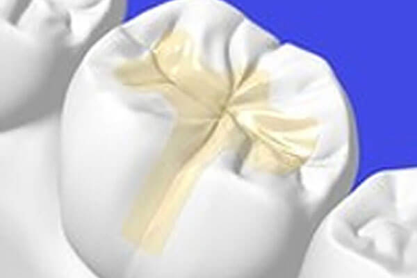 インレー（詰め物）