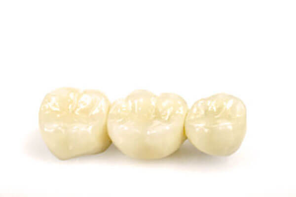 クラウン（被せ物）