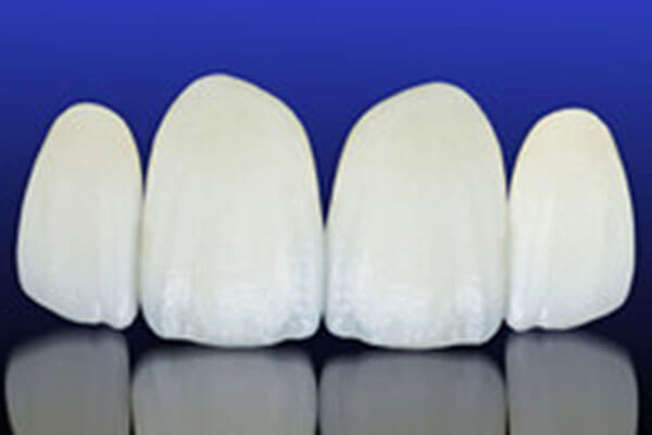 ラミネートベニア