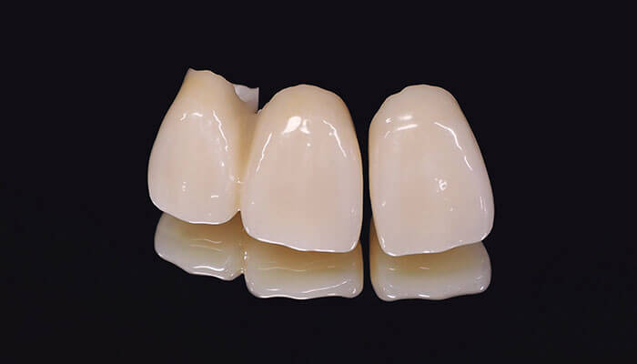 オールセラミックス