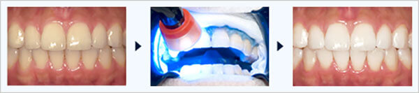 オフィスホワイトニング