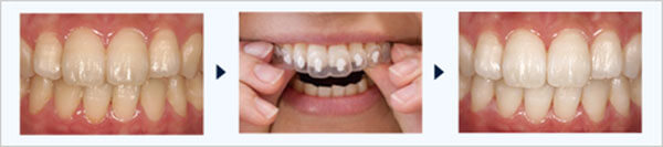 ホームホワイトニング